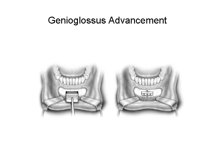 Genioglossus Advancement Genioglossus Advancement