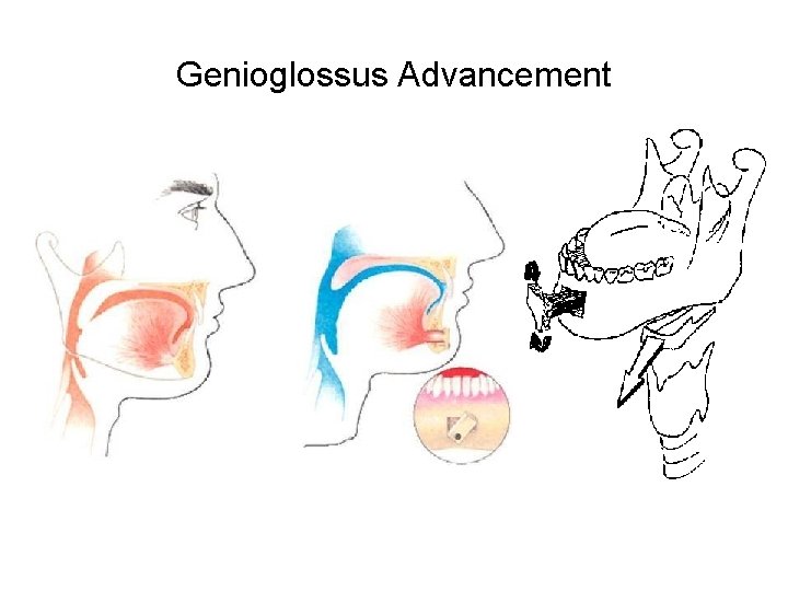 Genioglossus Advancement Genioglossus Advancement