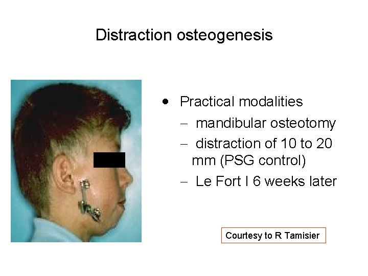 Distraction osteogenesis · Practical modalities - mandibular osteotomy - distraction of 10 to 20 Distraction osteogenesis · Practical modalities - mandibular osteotomy - distraction of 10 to 20