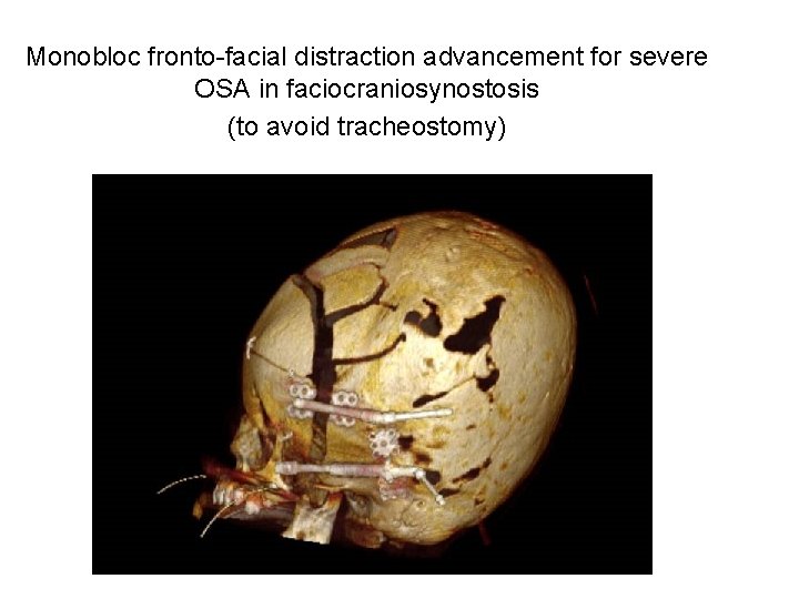 Monobloc fronto-facial distraction advancement for severe OSA in faciocraniosynostosis (to avoid tracheostomy) Monobloc fronto-facial distraction advancement for severe OSA in faciocraniosynostosis (to avoid tracheostomy)