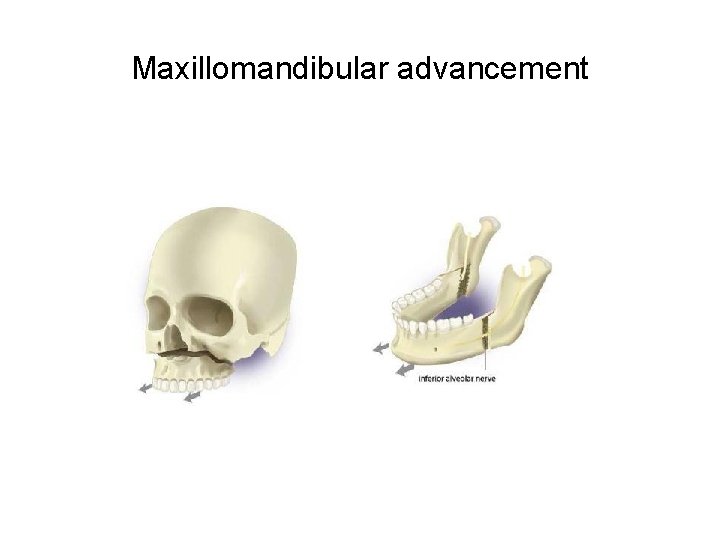 Maxillomandibular advancement Maxillomandibular advancement