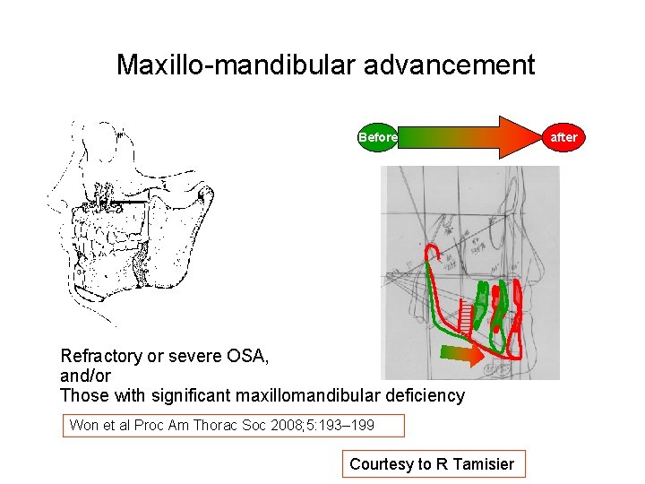 Maxillo-mandibular advancement Before Refractory or severe OSA, and/or Those with significant maxillomandibular deficiency Won Maxillo-mandibular advancement Before Refractory or severe OSA, and/or Those with significant maxillomandibular deficiency Won