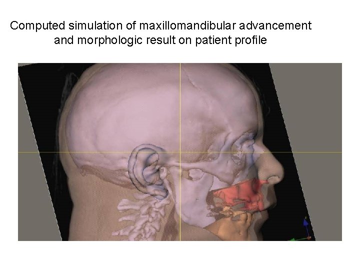 Computed simulation of maxillomandibular advancement and morphologic result on patient profile Computed simulation of maxillomandibular advancement and morphologic result on patient profile