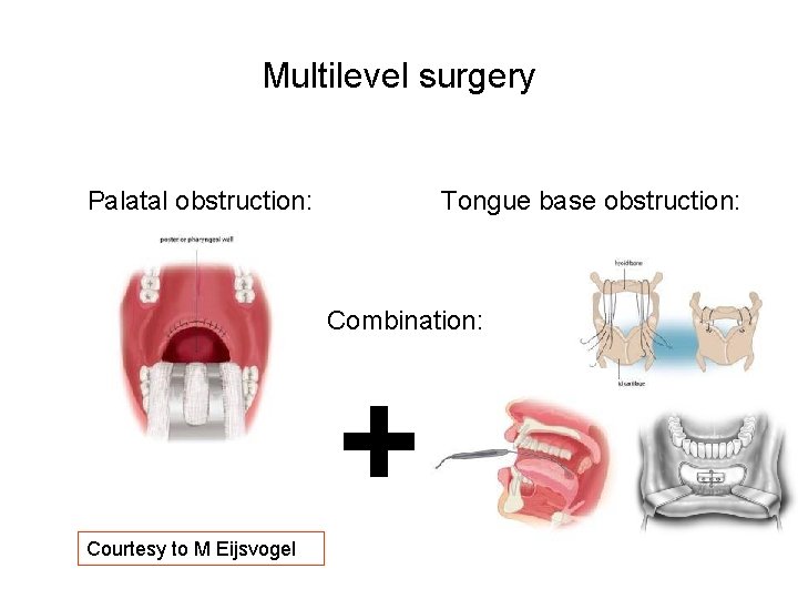 Multilevel surgery Palatal obstruction: Tongue base obstruction: Combination: + Courtesy to M Eijsvogel Multilevel surgery Palatal obstruction: Tongue base obstruction: Combination: + Courtesy to M Eijsvogel