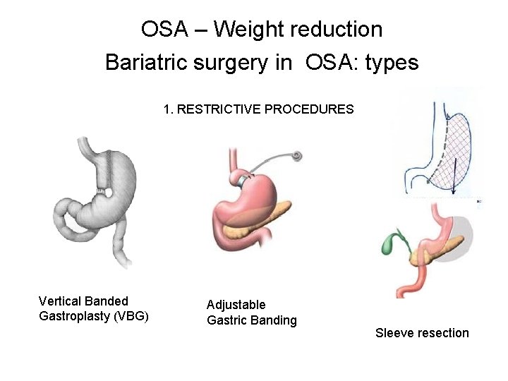 OSA – Weight reduction Bariatric surgery in OSA: types 1. RESTRICTIVE PROCEDURES Vertical Banded OSA – Weight reduction Bariatric surgery in OSA: types 1. RESTRICTIVE PROCEDURES Vertical Banded