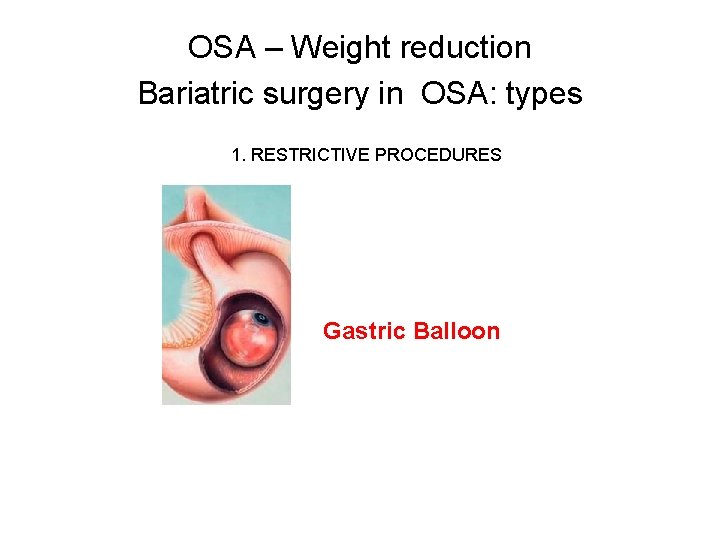 OSA – Weight reduction Bariatric surgery in OSA: types 1. RESTRICTIVE PROCEDURES Gastric Balloon OSA – Weight reduction Bariatric surgery in OSA: types 1. RESTRICTIVE PROCEDURES Gastric Balloon