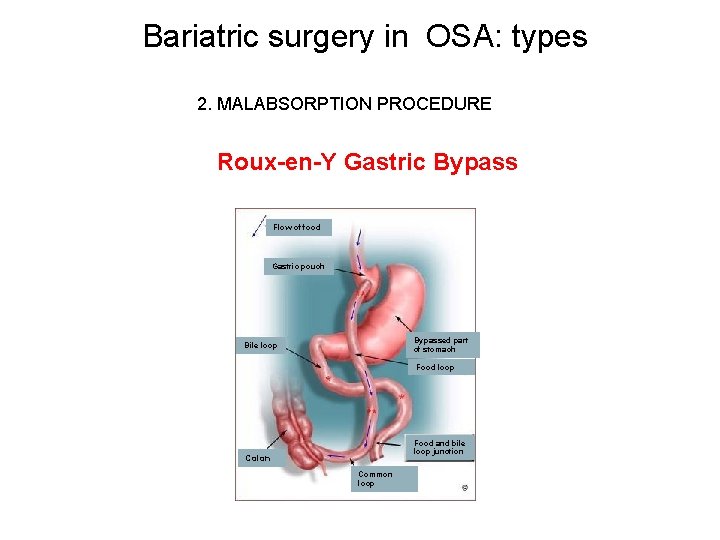 Bariatric surgery in OSA: types 2. MALABSORPTION PROCEDURE Roux-en-Y Gastric Bypass Flow of food Bariatric surgery in OSA: types 2. MALABSORPTION PROCEDURE Roux-en-Y Gastric Bypass Flow of food