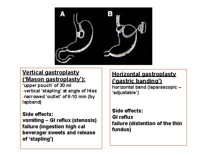 Vertical gastroplasty (‘Mason gastroplasty’): ‘upper pouch’ of 30 ml -vertical ‘stapling’ at angle of Vertical gastroplasty (‘Mason gastroplasty’): ‘upper pouch’ of 30 ml -vertical ‘stapling’ at angle of