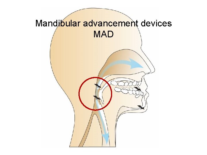 Mandibular advancement devices MAD Mandibular advancement devices MAD