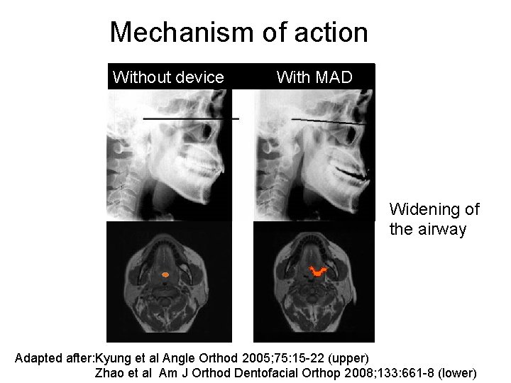 Mechanism of action Without device With MAD Widening of the airway Adapted after: Mechanism of action Without device With MAD Widening of the airway Adapted after:
