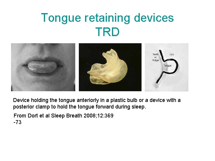 Tongue retaining devices TRD Device holding the tongue anteriorly in a plastic bulb or Tongue retaining devices TRD Device holding the tongue anteriorly in a plastic bulb or