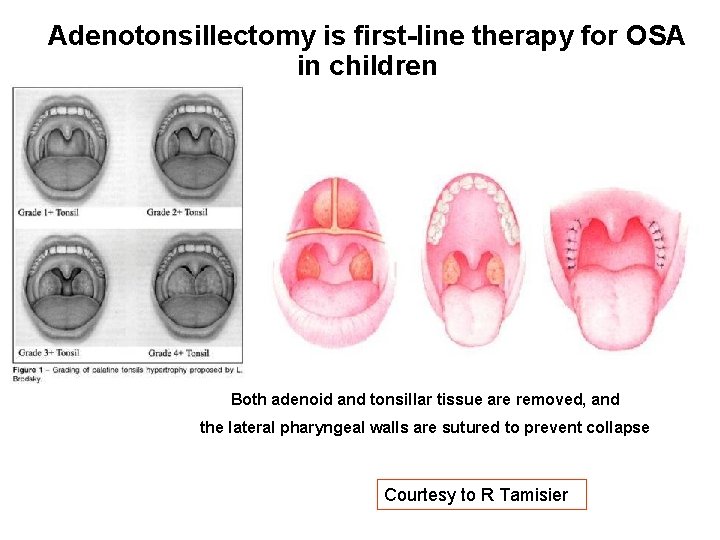 Adenotonsillectomy is first-line therapy for OSA in children Both adenoid and tonsillar tissue are Adenotonsillectomy is first-line therapy for OSA in children Both adenoid and tonsillar tissue are