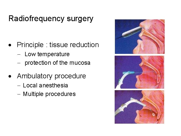 Radiofrequency surgery · Principle : tissue reduction - Low temperature - protection of the Radiofrequency surgery · Principle : tissue reduction - Low temperature - protection of the