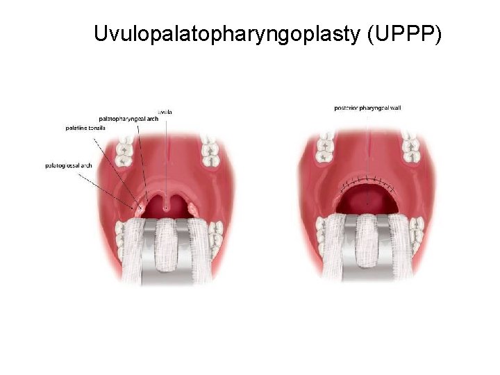 Uvulopalatopharyngoplasty (UPPP) Uvulopalatopharyngoplasty (UPPP)