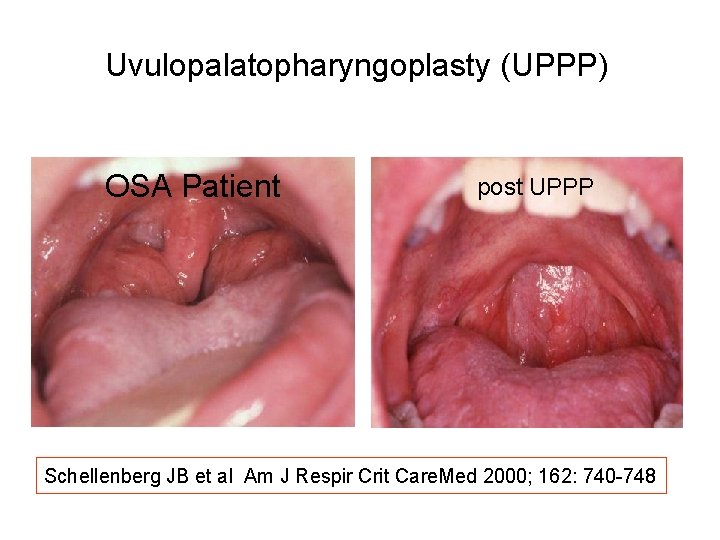 Uvulopalatopharyngoplasty (UPPP) OSA Patient post UPPP Schellenberg JB et al Am J Respir Crit Uvulopalatopharyngoplasty (UPPP) OSA Patient post UPPP Schellenberg JB et al Am J Respir Crit