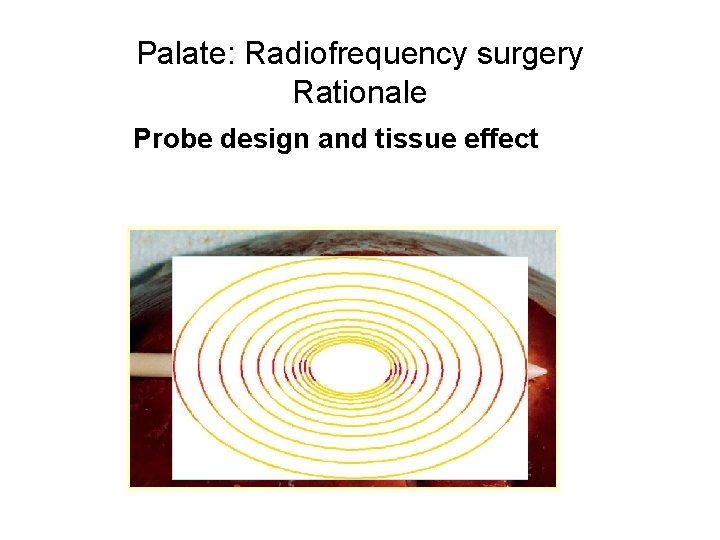 Palate: Radiofrequency surgery Rationale Probe design and tissue effect Palate: Radiofrequency surgery Rationale Probe design and tissue effect