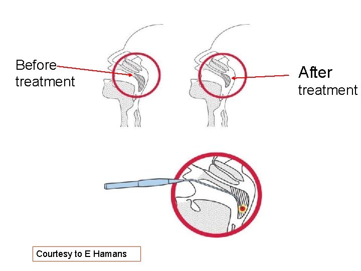 Before treatment Courtesy to E Hamans After treatment Before treatment Courtesy to E Hamans After treatment