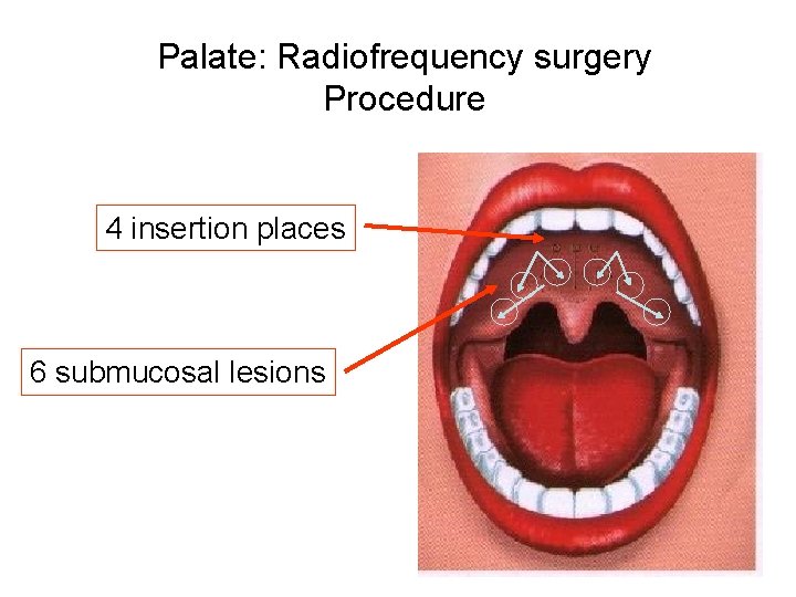 Palate: Radiofrequency surgery Procedure 4 insertion places 6 submucosal lesions Palate: Radiofrequency surgery Procedure 4 insertion places 6 submucosal lesions