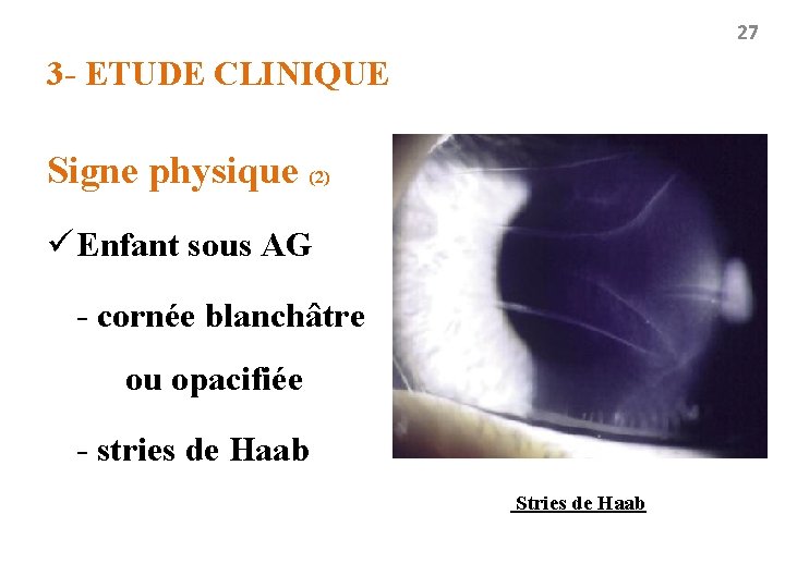 27 3 - ETUDE CLINIQUE Signe physique (2) ü Enfant sous AG - cornée