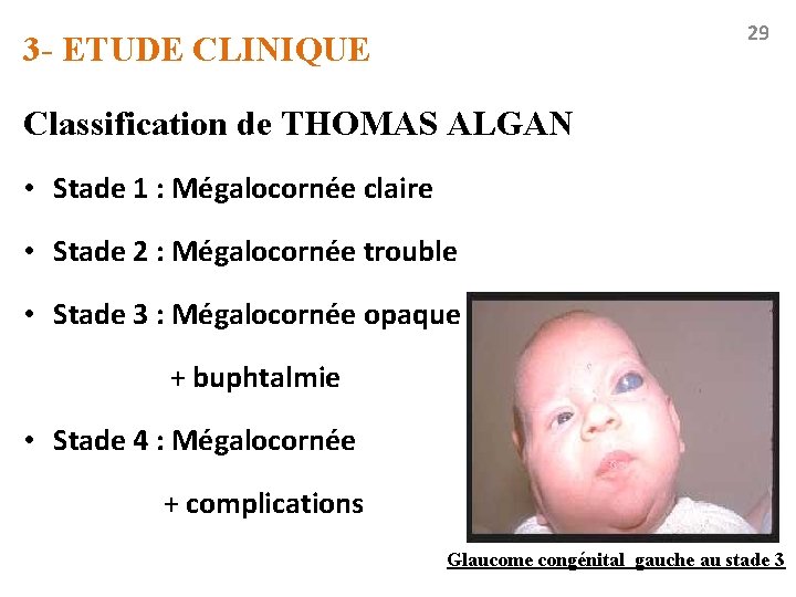 29 3 - ETUDE CLINIQUE Classification de THOMAS ALGAN • Stade 1 : Mégalocornée