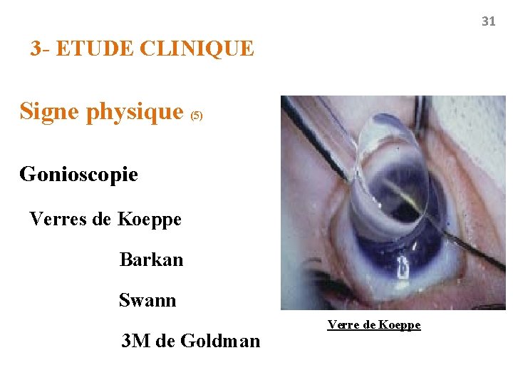 31 3 - ETUDE CLINIQUE Signe physique (5) Gonioscopie Verres de Koeppe Barkan Swann