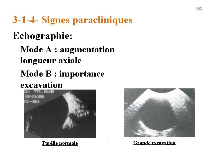 34 3 -1 -4 - Signes paracliniques Echographie: Mode A : augmentation longueur axiale