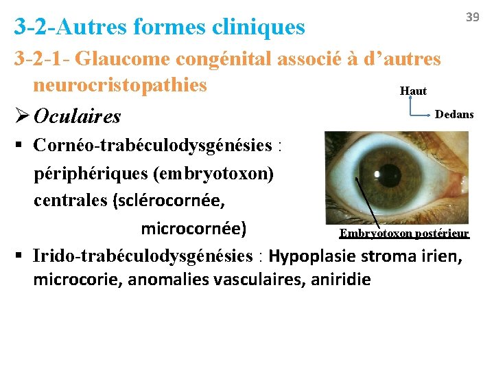 3 -2 -Autres formes cliniques 39 3 -2 -1 - Glaucome congénital associé à