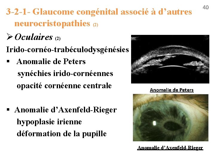 3 -2 -1 - Glaucome congénital associé à d’autres neurocristopathies (2) Ø Oculaires (2)