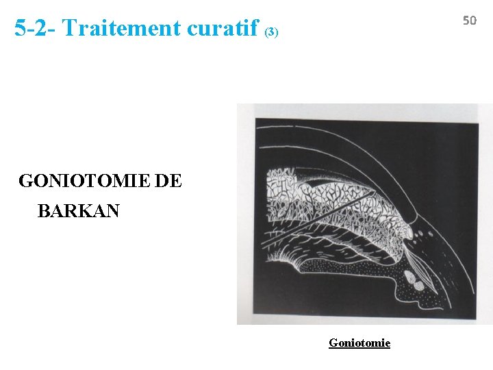 50 5 -2 - Traitement curatif (3) GONIOTOMIE DE BARKAN Goniotomie 