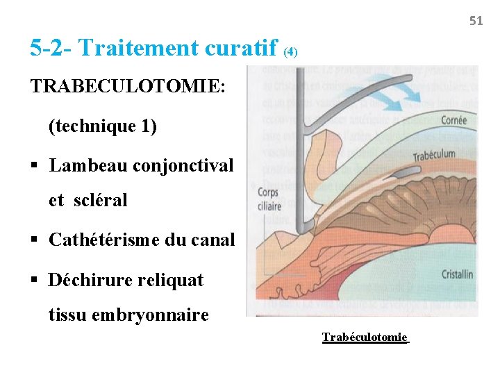 51 5 -2 - Traitement curatif (4) TRABECULOTOMIE: (technique 1) § Lambeau conjonctival et