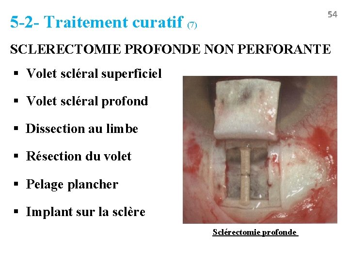 54 5 -2 - Traitement curatif (7) SCLERECTOMIE PROFONDE NON PERFORANTE § Volet scléral