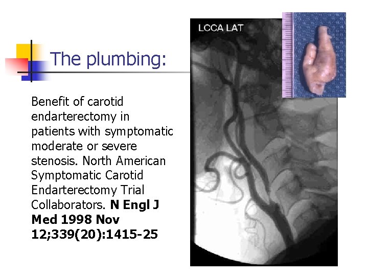 The plumbing: Benefit of carotid endarterectomy in patients with symptomatic moderate or severe stenosis.