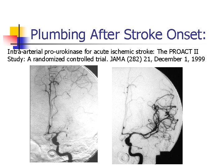 Plumbing After Stroke Onset: Intra-arterial pro-urokinase for acute ischemic stroke: The PROACT II Study: