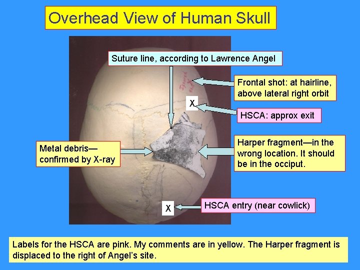 Overhead View of Human Skull Suture line, according to Lawrence Angel Frontal shot: at Overhead View of Human Skull Suture line, according to Lawrence Angel Frontal shot: at
