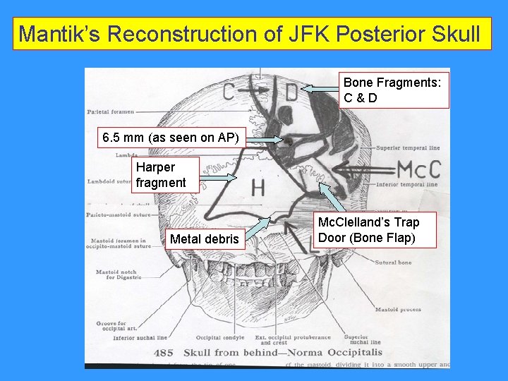 Mantik’s Reconstruction of JFK Posterior Skull Bone Fragments: C & D 6. 5 mm Mantik’s Reconstruction of JFK Posterior Skull Bone Fragments: C & D 6. 5 mm