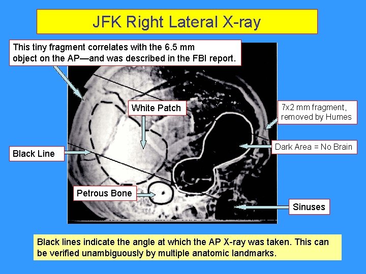 JFK Right Lateral X-ray This tiny fragment correlates with the 6. 5 mm object JFK Right Lateral X-ray This tiny fragment correlates with the 6. 5 mm object