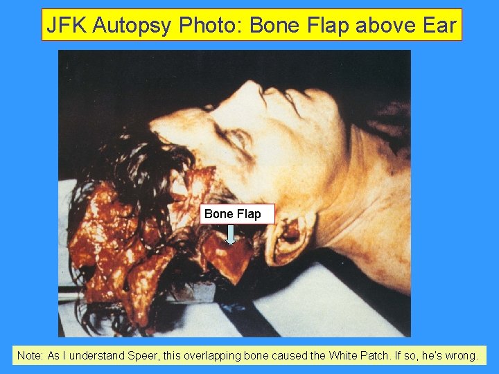 JFK Autopsy Photo: Bone Flap above Ear Bone Flap Note: As I understand Speer, JFK Autopsy Photo: Bone Flap above Ear Bone Flap Note: As I understand Speer,