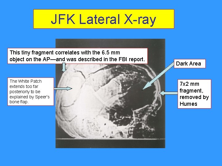 JFK Lateral X-ray This tiny fragment correlates with the 6. 5 mm object on JFK Lateral X-ray This tiny fragment correlates with the 6. 5 mm object on