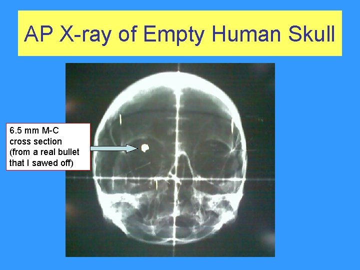 AP X-ray of Empty Human Skull 6. 5 mm M-C cross section (from a AP X-ray of Empty Human Skull 6. 5 mm M-C cross section (from a