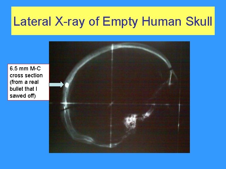 Lateral X-ray of Empty Human Skull 6. 5 mm M-C cross section (from a Lateral X-ray of Empty Human Skull 6. 5 mm M-C cross section (from a