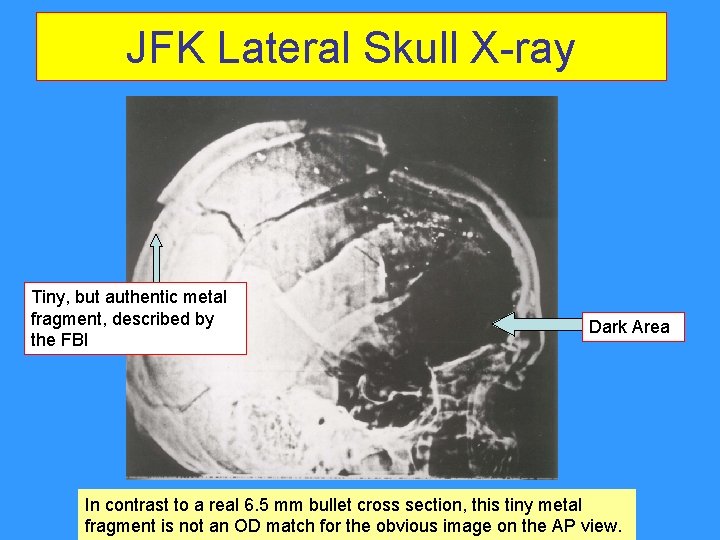 JFK Lateral Skull X-ray Tiny, but authentic metal fragment, described by the FBI Dark JFK Lateral Skull X-ray Tiny, but authentic metal fragment, described by the FBI Dark