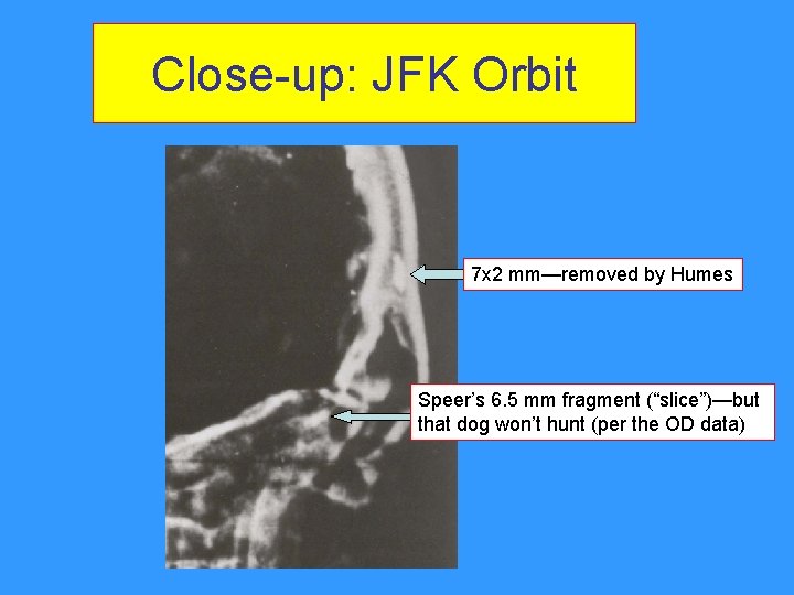Close-up: JFK Orbit 7 x 2 mm—removed by Humes Speer’s 6. 5 mm fragment Close-up: JFK Orbit 7 x 2 mm—removed by Humes Speer’s 6. 5 mm fragment