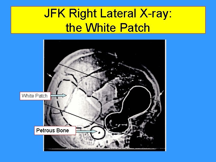 JFK Right Lateral X-ray: the White Patch Petrous Bone JFK Right Lateral X-ray: the White Patch Petrous Bone