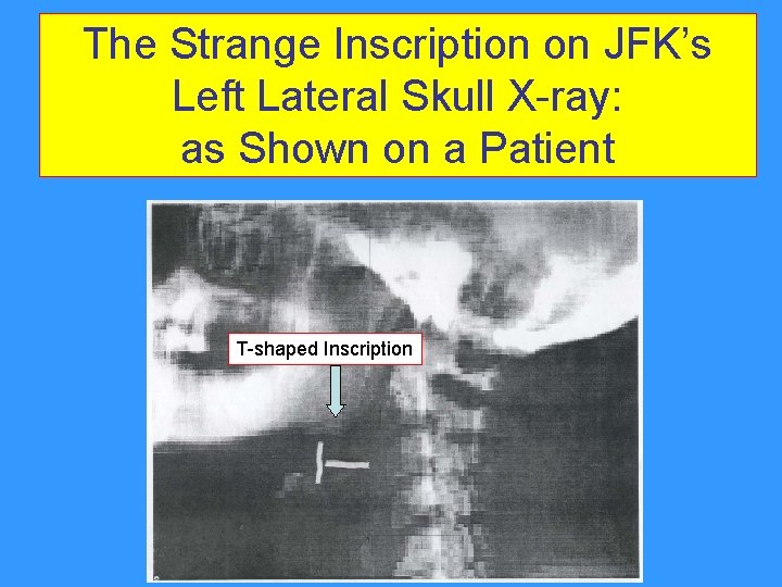 The Strange Inscription on JFK’s Left Lateral Skull X-ray: as Shown on a Patient The Strange Inscription on JFK’s Left Lateral Skull X-ray: as Shown on a Patient