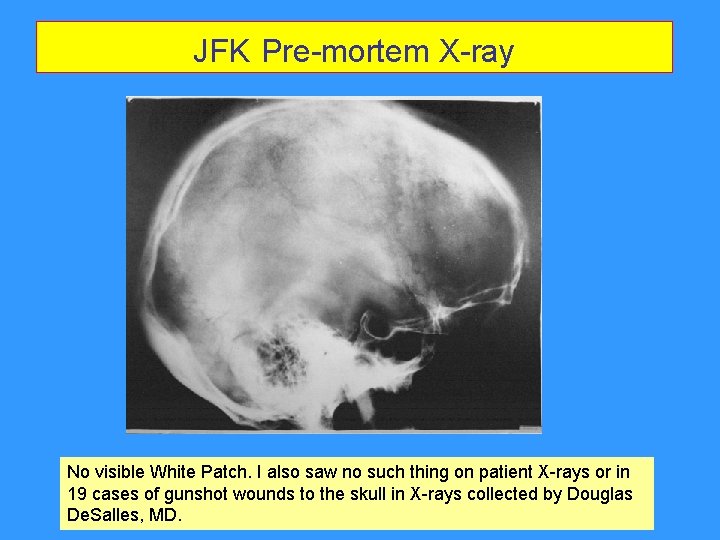 JFK Pre-mortem X-ray No visible White Patch. I also saw no such thing on JFK Pre-mortem X-ray No visible White Patch. I also saw no such thing on