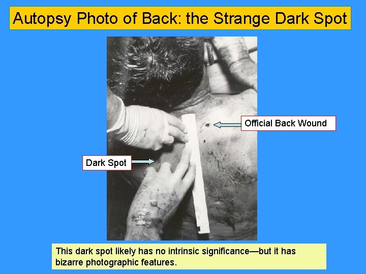 Autopsy Photo of Back: the Strange Dark Spot Official Back Wound Dark Spot This Autopsy Photo of Back: the Strange Dark Spot Official Back Wound Dark Spot This