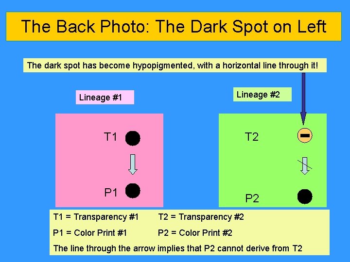 The Back Photo: The Dark Spot on Left The dark spot has become hypopigmented, The Back Photo: The Dark Spot on Left The dark spot has become hypopigmented,