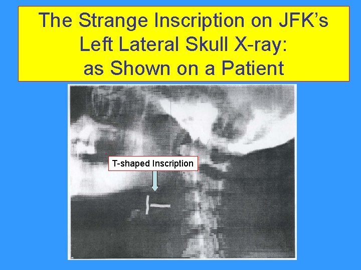 The Strange Inscription on JFK’s Left Lateral Skull X-ray: as Shown on a Patient The Strange Inscription on JFK’s Left Lateral Skull X-ray: as Shown on a Patient