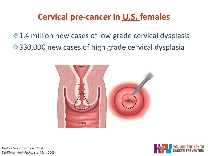 Cervical pre-cancer in U. S. females ´ 1. 4 million new cases of low Cervical pre-cancer in U. S. females ´ 1. 4 million new cases of low