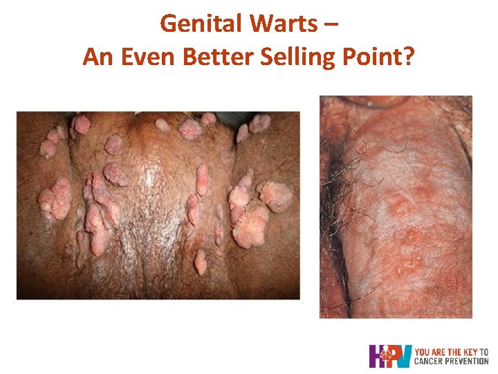Genital Warts – An Even Better Selling Point? Genital Warts – An Even Better Selling Point?